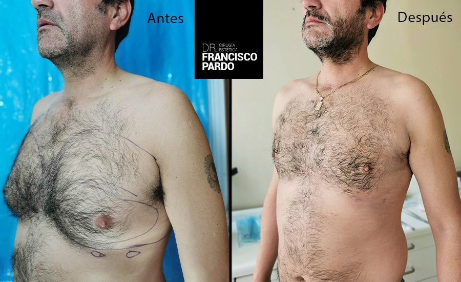 Ginecomastias – Dr Francisco Pardo